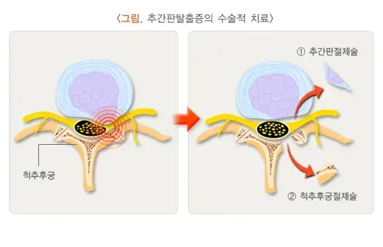 추간판탈출증(디스크) 비약물 치료 설명 이미지 2