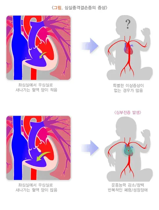 심실중격결손증 증상 설명 이미지 1