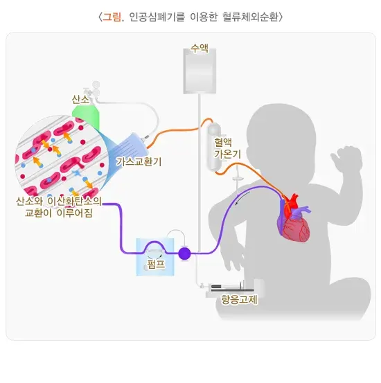 심실중격결손증 비약물 치료 설명 이미지 1