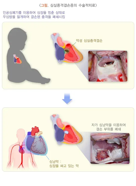 심실중격결손증 비약물 치료 설명 이미지 2