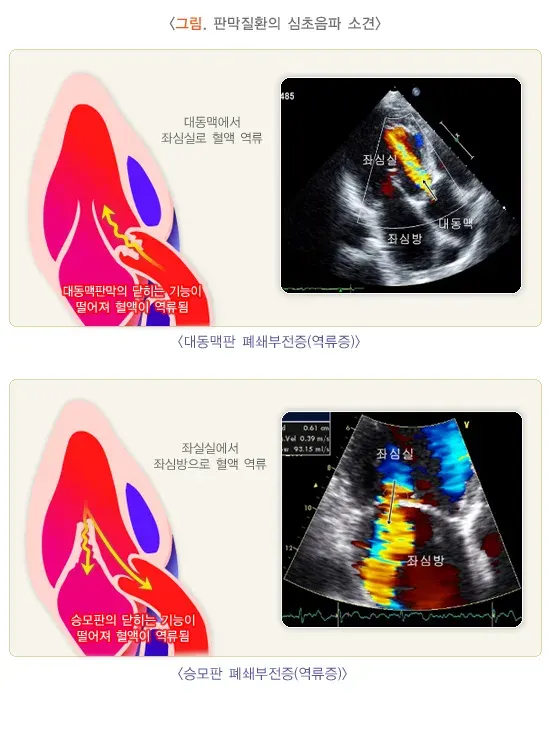 심초음파검사 검사 결과 해석 설명 이미지 1