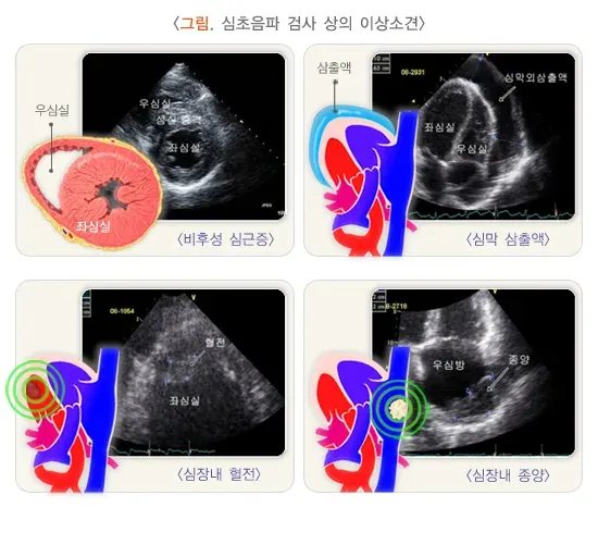 심초음파검사 검사 결과 해석 설명 이미지 3