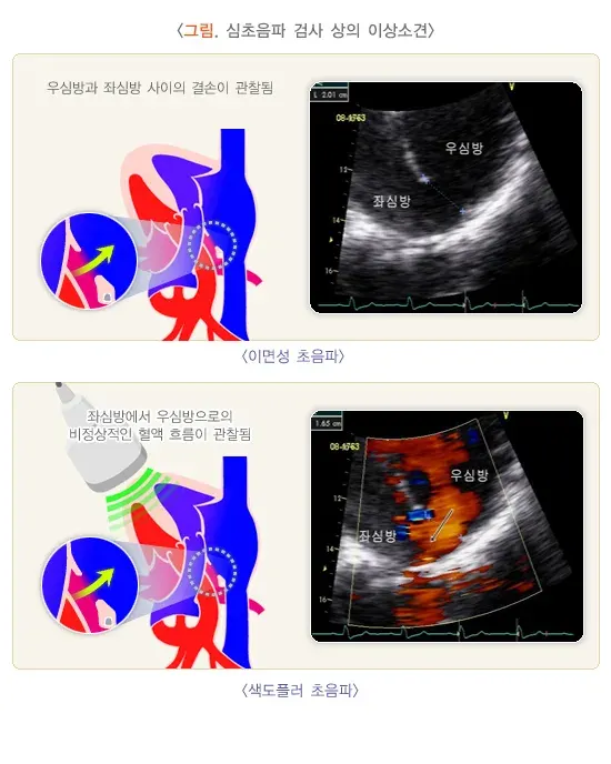 심초음파검사 검사 결과 해석 설명 이미지 4