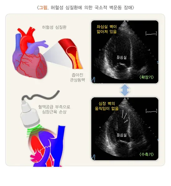 심초음파검사 검사 결과 해석 설명 이미지 2