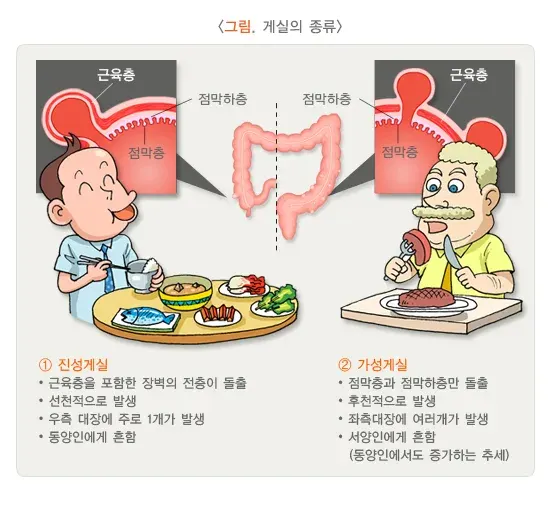 대장게실증 종류 설명 이미지 1