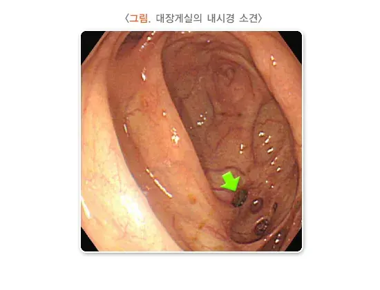대장게실증 진단 및 검사 설명 이미지 1