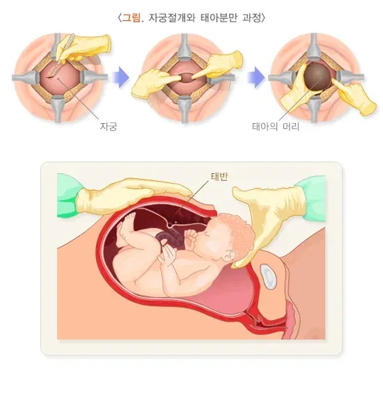 제왕절개술 치료 방법 설명 이미지 4