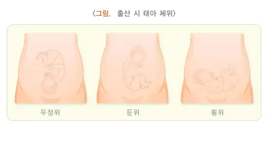제왕절개술 치료 방법 설명 이미지 3