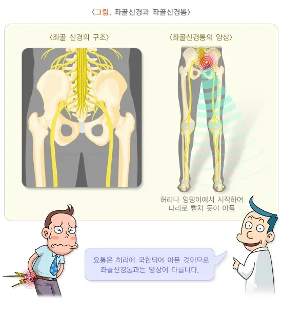 좌골신경통 정의 설명 이미지 1