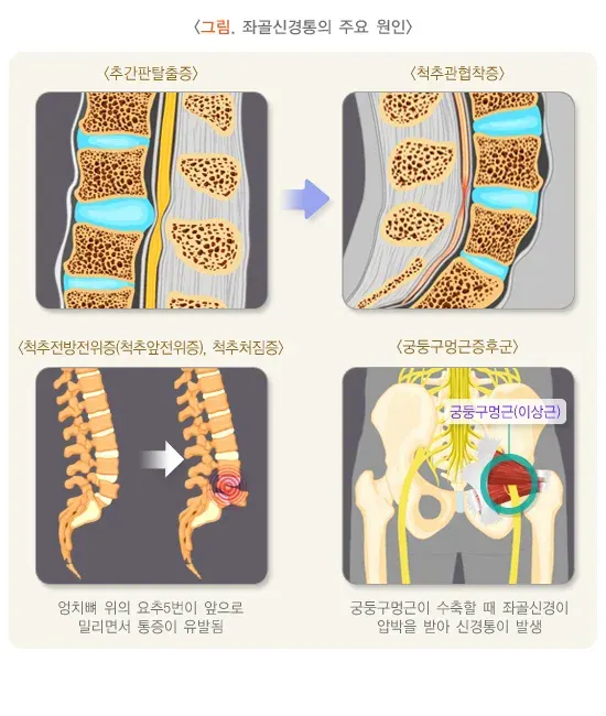 좌골신경통 원인 설명 이미지 1