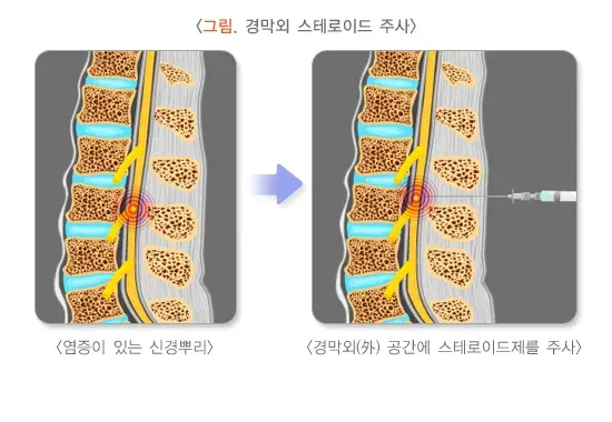 좌골신경통 치료 설명 이미지 1