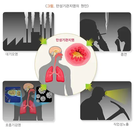 만성기관지염 원인 설명 이미지 1