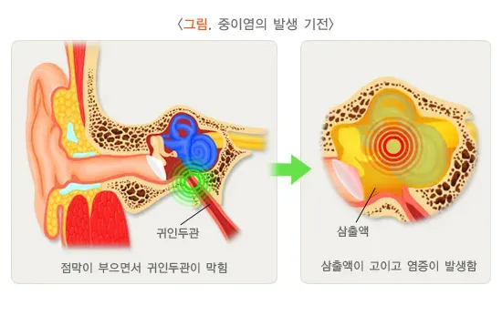 중이염 병태생리 설명 이미지 1
