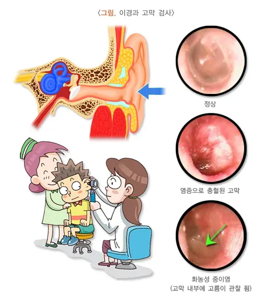 중이염 진단 및 검사 설명 이미지 1