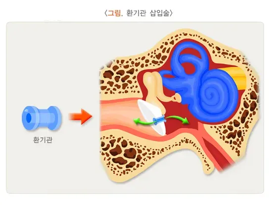 중이염 비약물 치료 설명 이미지 1