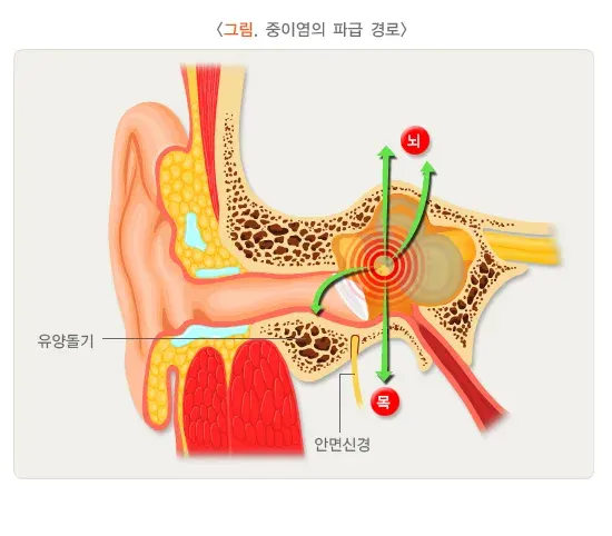 중이염 합병증 설명 이미지 1
