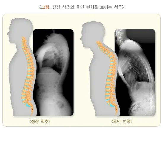 척추의 형태 이상(척추후만증) 정의 설명 이미지 1