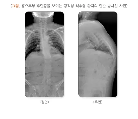 척추의 형태 이상(척추후만증) 종류 설명 이미지 2