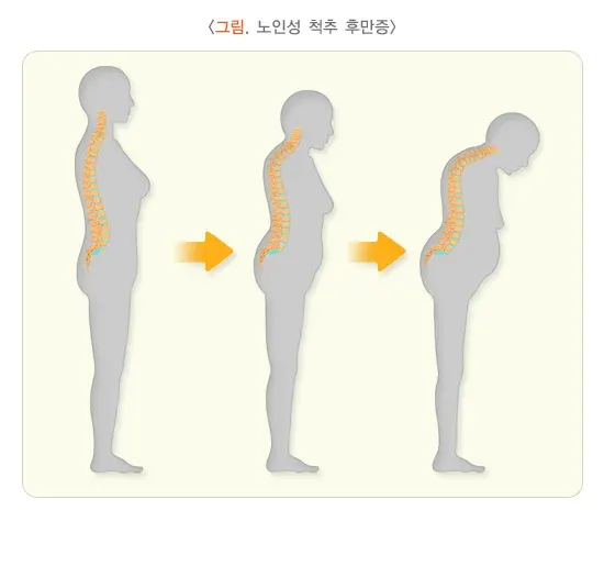 척추의 형태 이상(척추후만증) 종류 설명 이미지 4