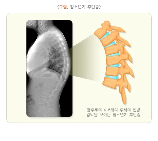척추의 형태 이상(척추후만증) 종류 설명 이미지 1