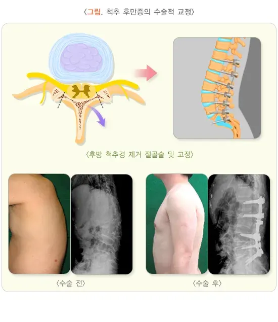 척추의 형태 이상(척추후만증) 치료 설명 이미지 1