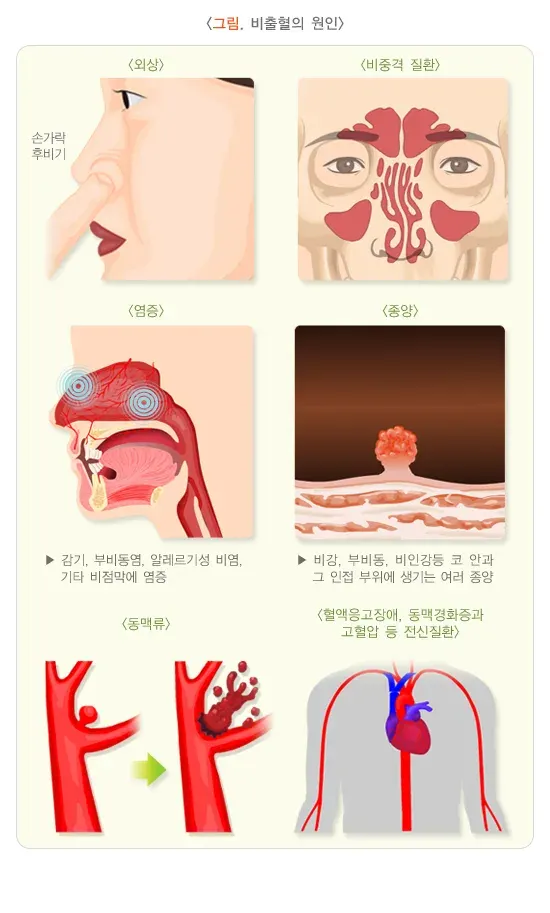 코피(비출혈) 원인 설명 이미지 1