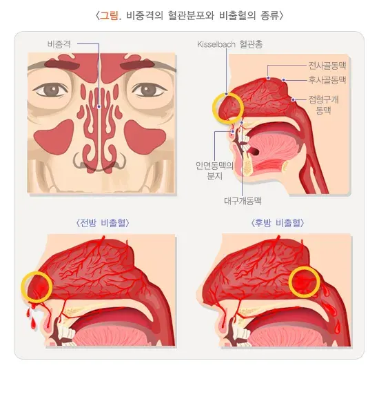 코피(비출혈) 역학 및 통계 설명 이미지 1