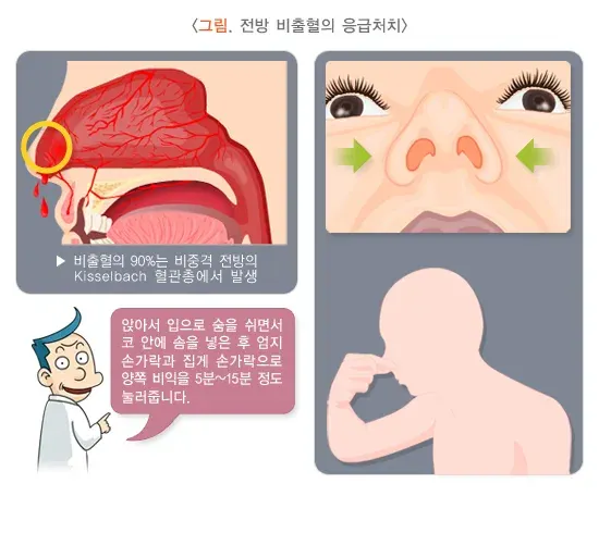 코피(비출혈) 치료 설명 이미지 1