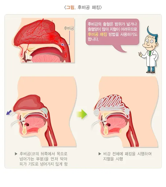 코피(비출혈) 치료 설명 이미지 3