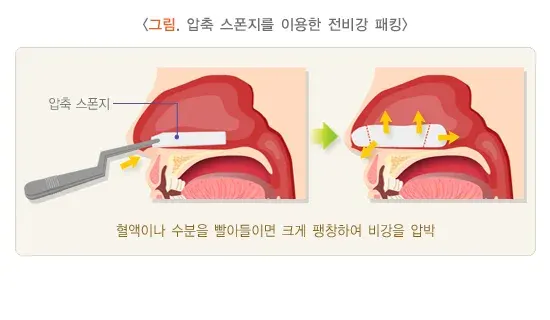 코피(비출혈) 치료 설명 이미지 2