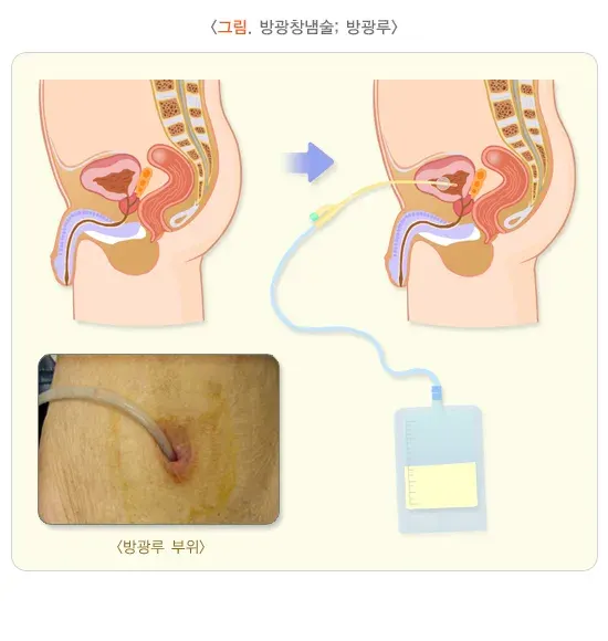 요로전환술(방광창냄술) 치료 방법 설명 이미지 1