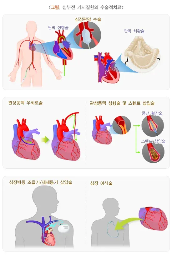 심부전 비약물 치료 설명 이미지 1