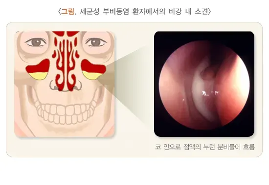 기침(성인) 관련 질환 설명 이미지 2