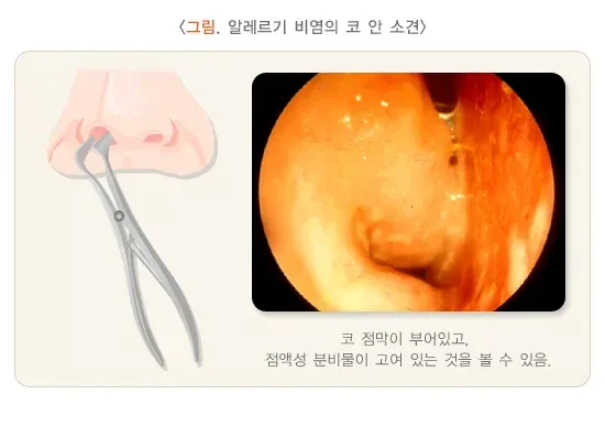 기침(성인) 관련 질환 설명 이미지 1
