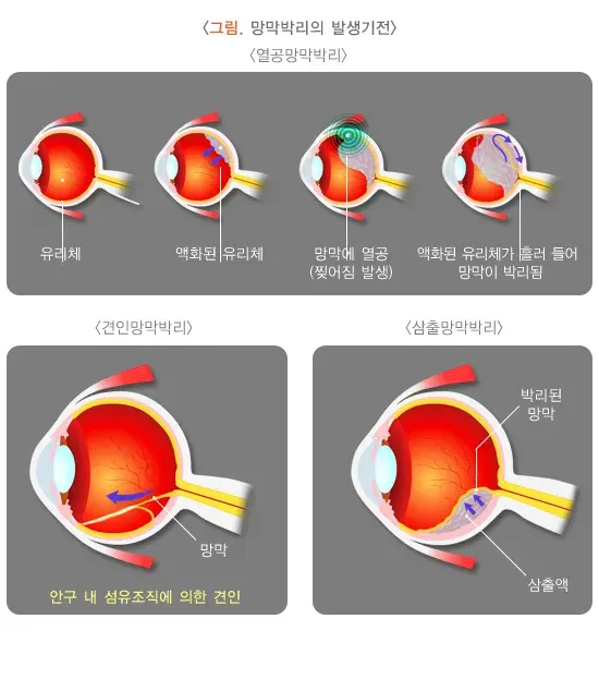 망막박리 종류 설명 이미지 1