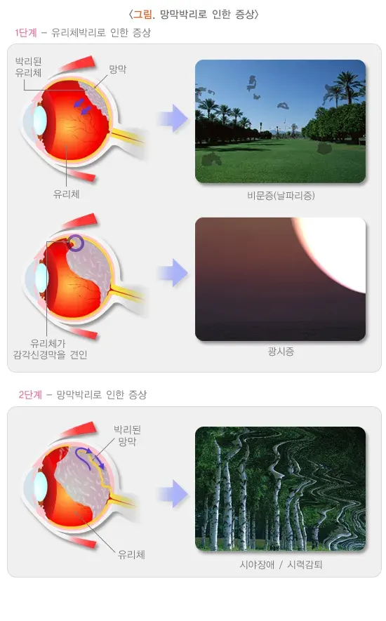 망막박리 증상 설명 이미지 1