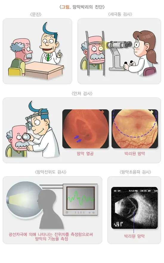 망막박리 진단 및 검사 설명 이미지 1
