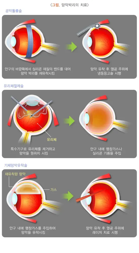 망막박리 치료 설명 이미지 2
