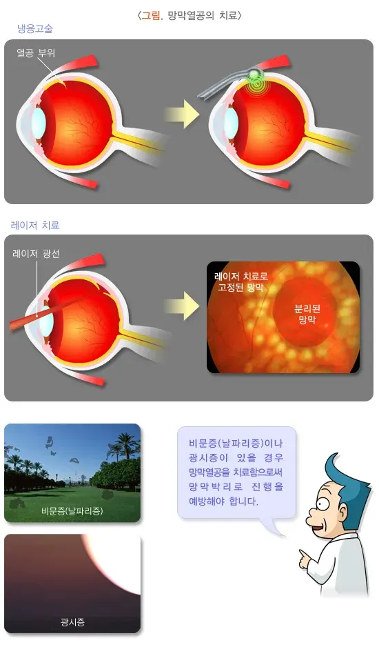 망막박리 치료 설명 이미지 1