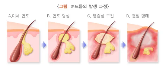 여드름 원인 설명 이미지 2