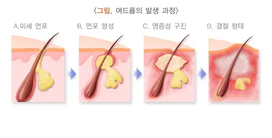 여드름 원인 설명 이미지 2