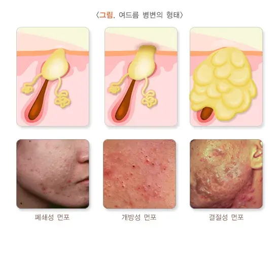 여드름 증상 설명 이미지 1