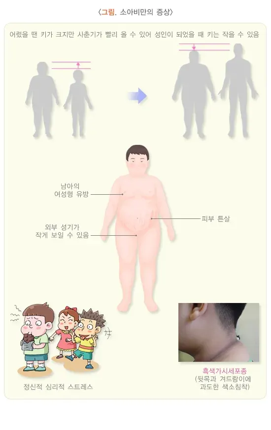 소아 비만 증상 설명 이미지 1