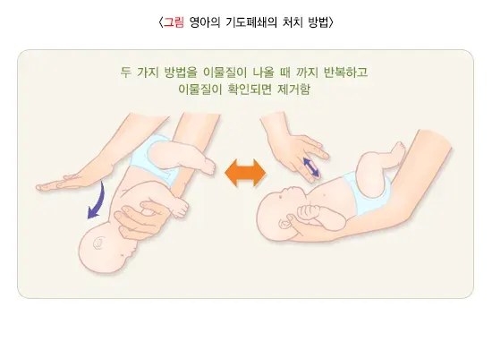 심폐소생술(이물질에 의한 기도폐쇄의 처치) 치료 방법 설명 이미지 2