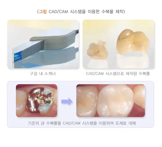 아말감 및 인레이(치아색 인레이) 치료 방법 설명 이미지 1