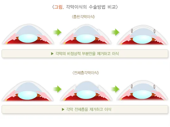 각막이식 치료 방법 설명 이미지 1