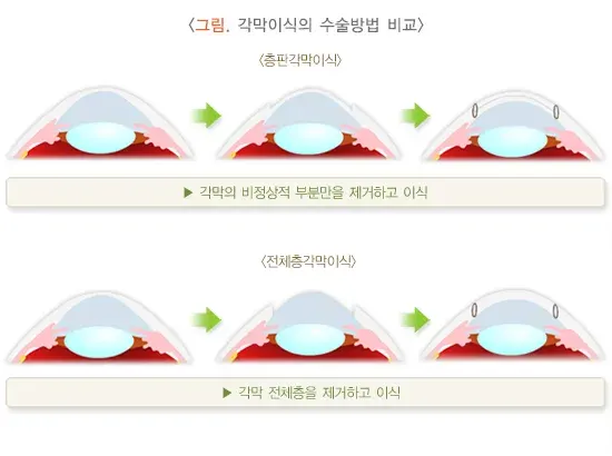 각막이식 치료 방법 설명 이미지 1