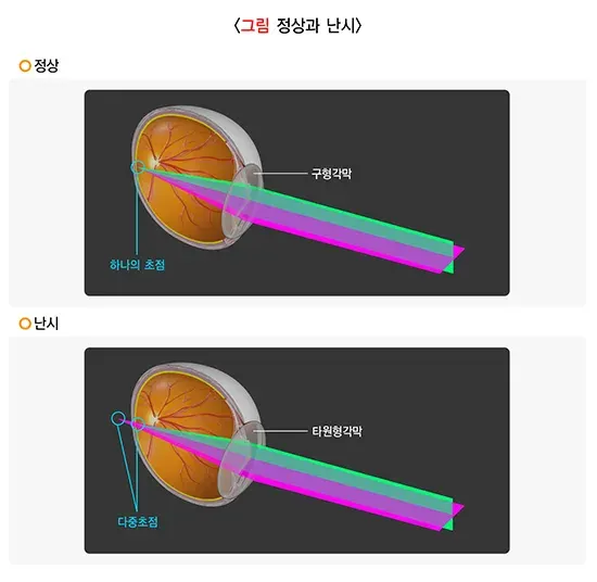 굴절이상(근시, 원시, 난시) 정의 설명 이미지 2
