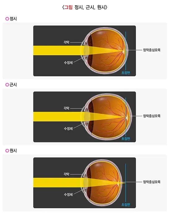 굴절이상(근시, 원시, 난시) 정의 설명 이미지 1