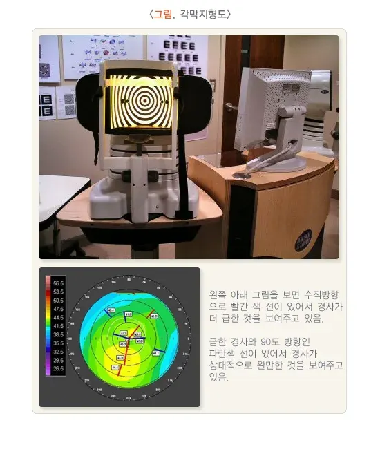 굴절이상(근시, 원시, 난시) 진단 및 검사 설명 이미지 2